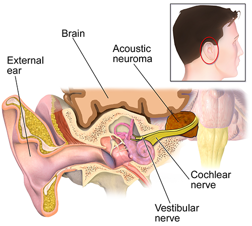 vestibular neuronitis, acoustic neuroma, Menieres Disease, Benign Paroxysmal Positional Vertigo, BPPV, otoxicity, stroke, trauma